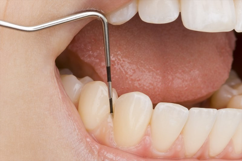 歯周病は早めに治療することが大切です