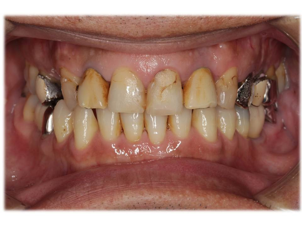 流山・柏地域の歯科医院で銀歯が目立たない治療をしております 