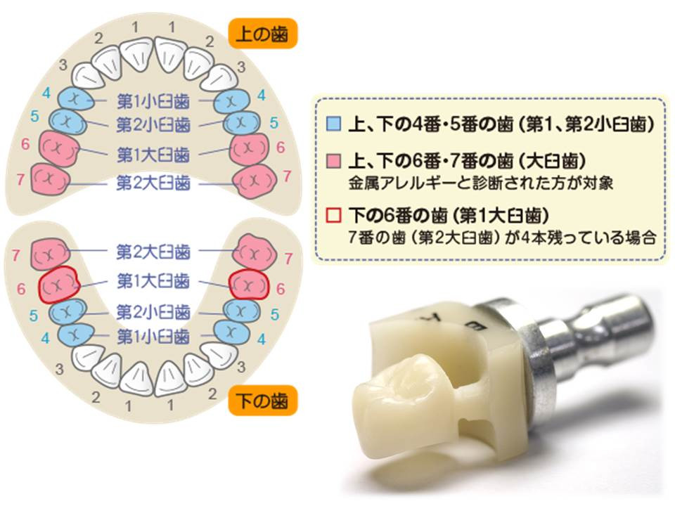 流山の歯科医院で高強度レジンブロック「CAD/CAM冠」の治療が受けられます。