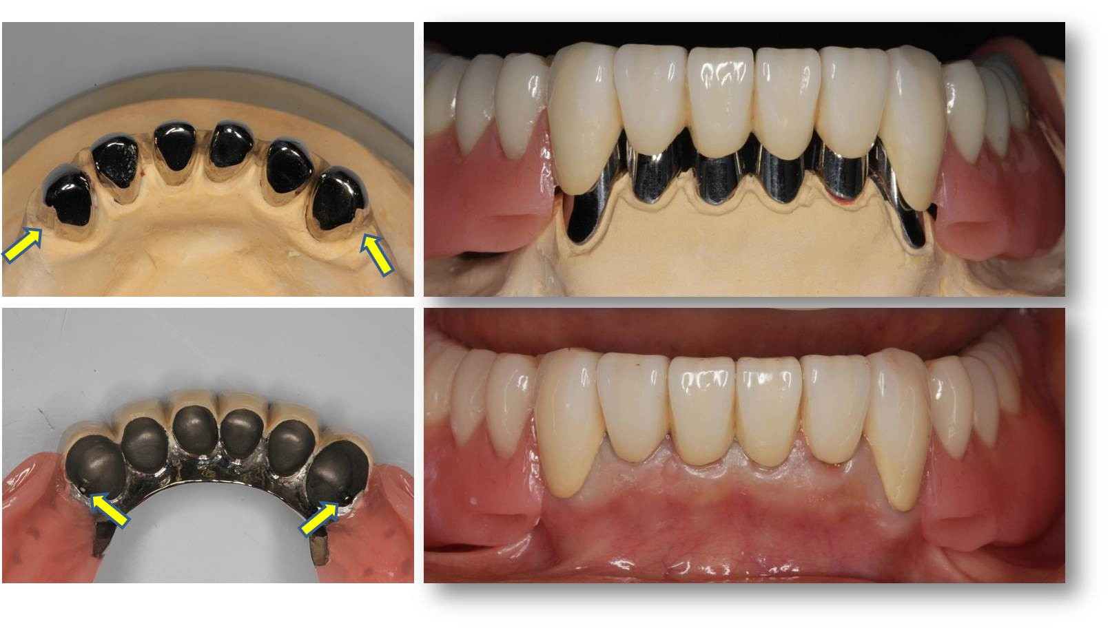 流山の歯科医院で生体にとって安全な金属「チタン」を用いた補綴治療をしております。