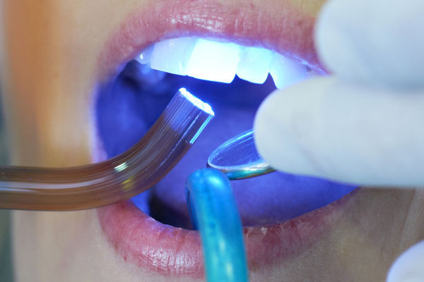 流山の歯科医院で高分子材料「レジン」を用いた歯科治療を行っております。
