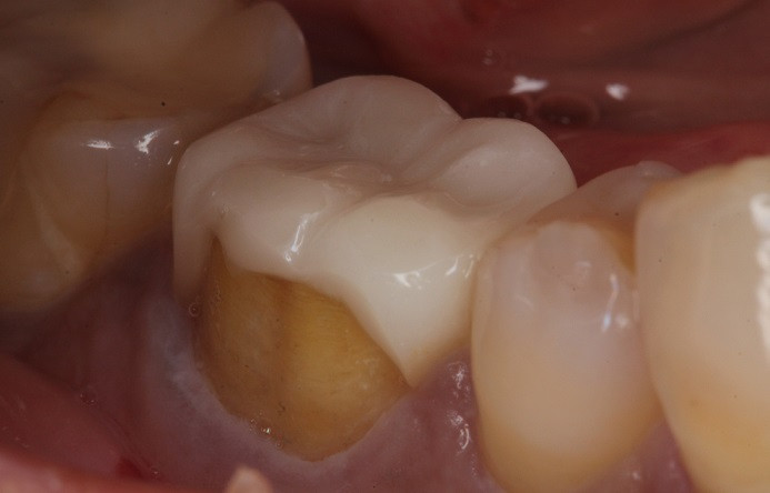 流山の歯科医院で被せ物に関するトラブルについての相談を承っております。