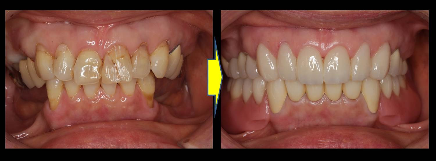 流山の歯科医院で「セラミックス」と「テレスコープ」を用いて歯並び・かみ合わせの改善を行っております。