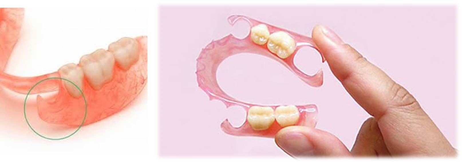 流山のグランツ歯科クリニックは「ナイロン義歯」や「スマイルデンチャー」を推奨しません。