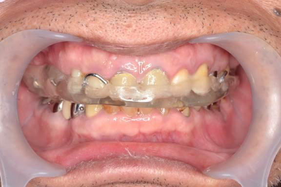 流山の歯科医院で「歯ぎしりによる咬耗・摩耗」を防ぐマウスピースの装着を推奨しております。