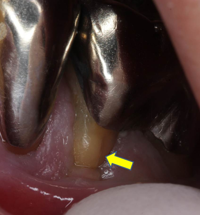 流山の歯科医院で被せ物の下の二次齲蝕の早期発見・早期治療に努めています。