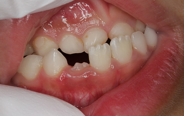 流山の歯科医院で「乳歯列期の反対咬合」の早期発見・治療に力を入れております。