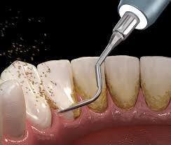 流山の歯科医院で「歯周病治療と予防歯科」に力を入れております。