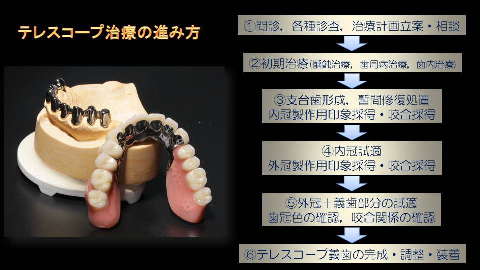 流山の歯科医院で「テレスコープ義歯」による入れ歯の専門治療を推奨しております。