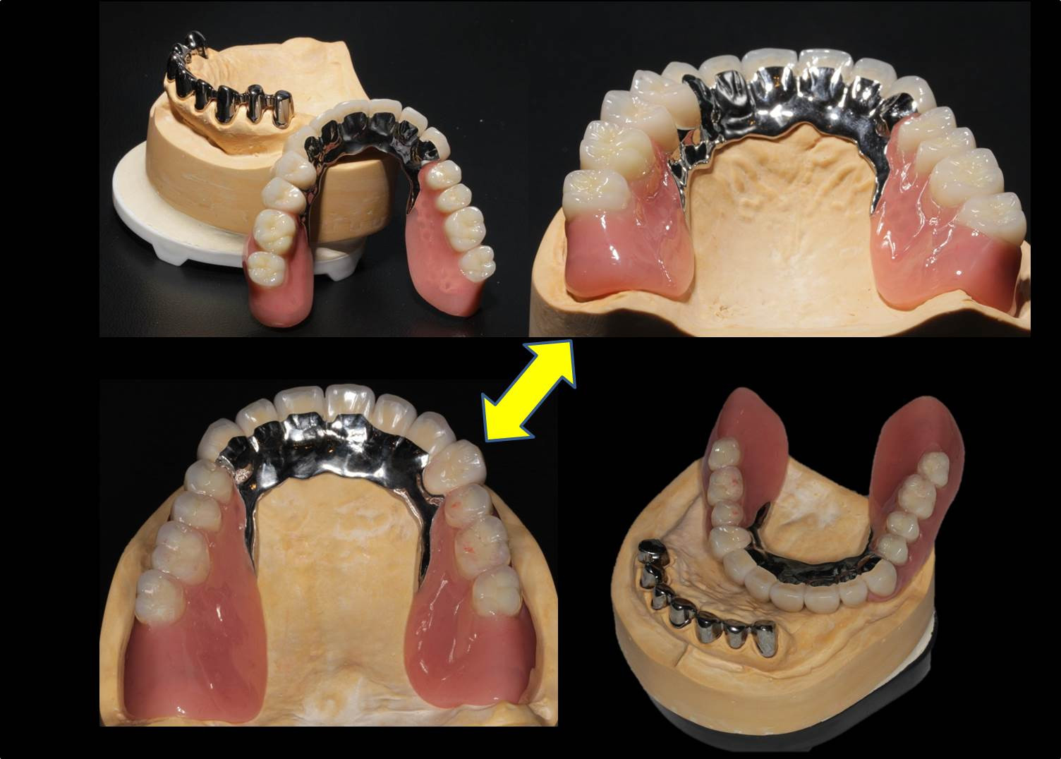流山の歯科医院で「テレスコープ義歯」によるドイツ式入れ歯治療をご提案しております。