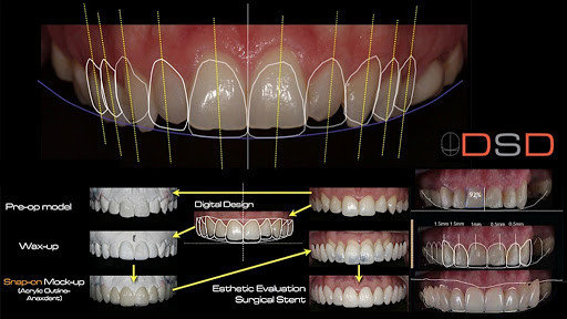 流山の歯科医院で「前歯の機能と審美」を改善させる被せ物による補綴治療を行なっております。