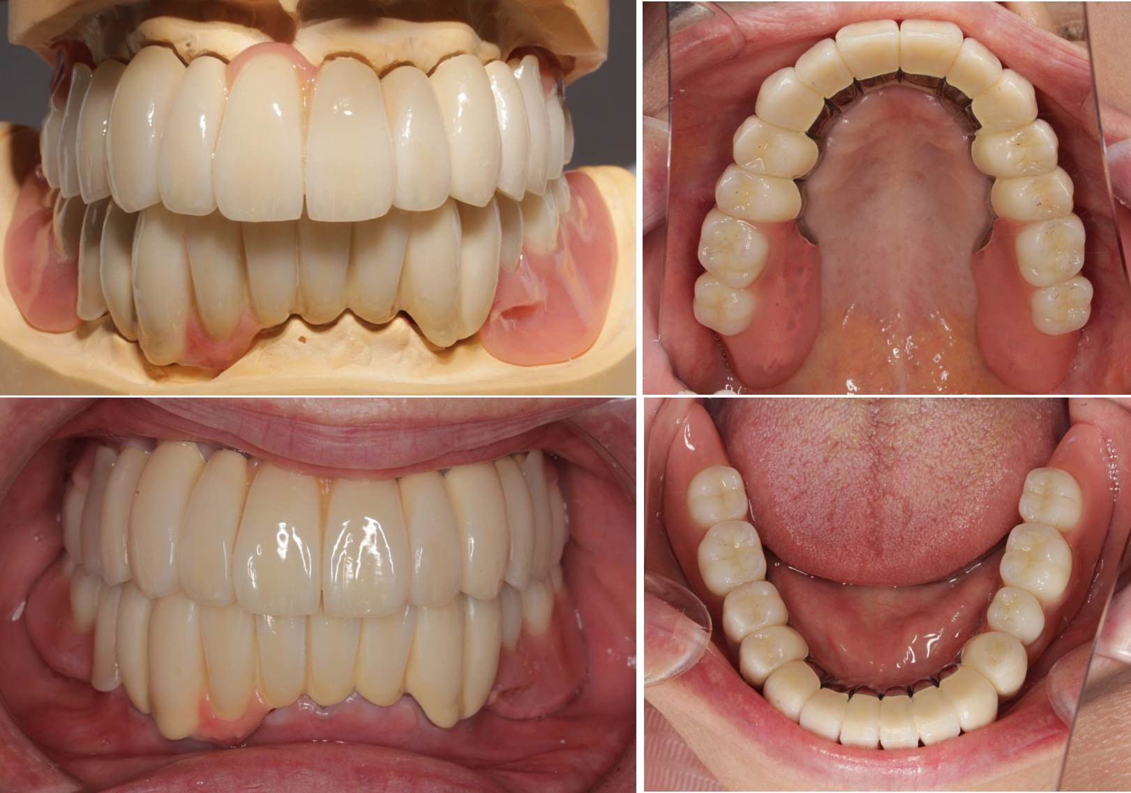 流山の歯科医院で「チタン合金製フリクションピン テレスコープ」を用いた精密義歯治療を行なっております。