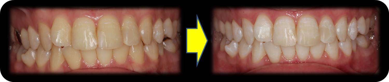 流山の歯科医院で「ホワイトニング」で歯を白くする治療を推奨しています。