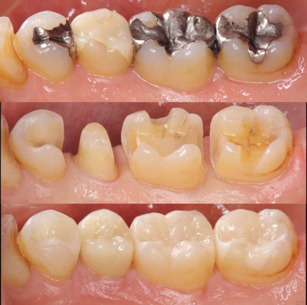 流山の歯科医院で「メタルフリー材料による齲蝕(むし歯)治療」を推奨しています。