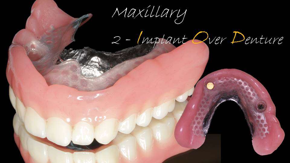 流山のグランツ歯科クリニックでは「よく咬めて違和感が少ない総入れ歯」の治療が受けられます。