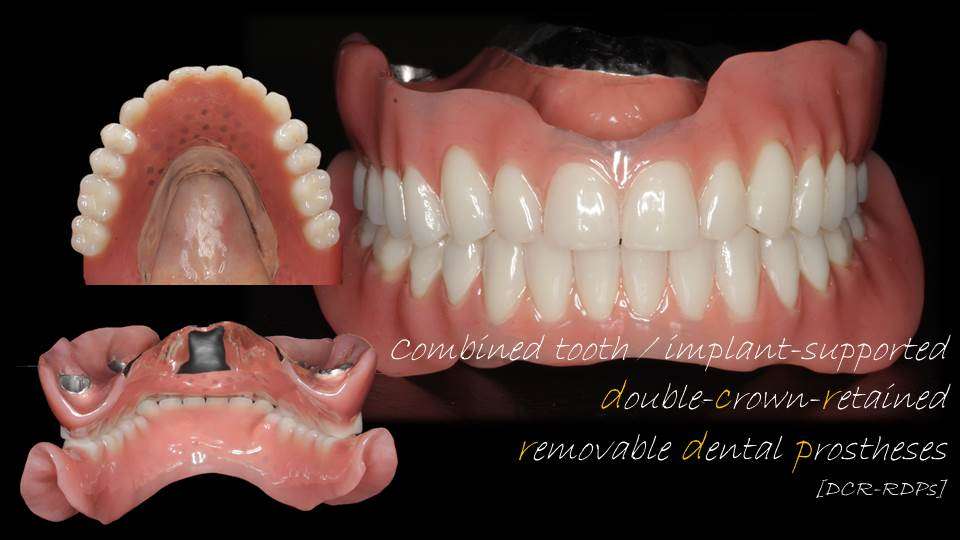 流山のグランツ歯科クリニックでは「グラグラな歯」で「ボロボロな入れ歯」でも治療が受けられます。